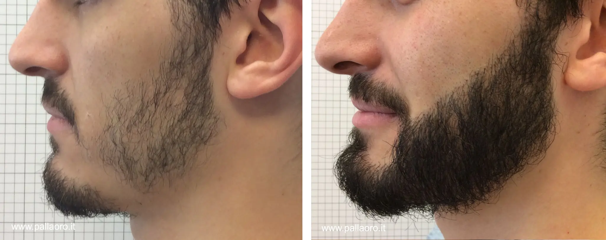 Prix d&rsquo;une Greffe de Barbe : Ce Qu&rsquo;il Faut Savoir